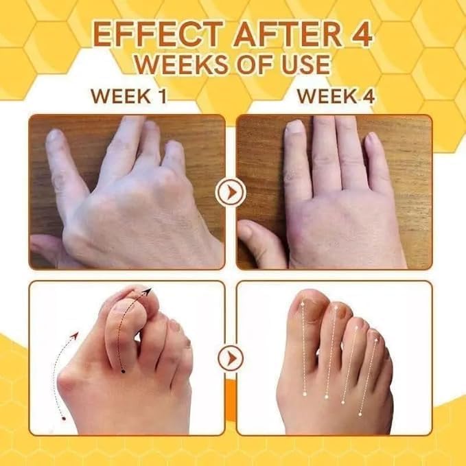 Bees Venom Spray Natural Relief For Varicose Veins & Spider Veins (Pack Of 2)